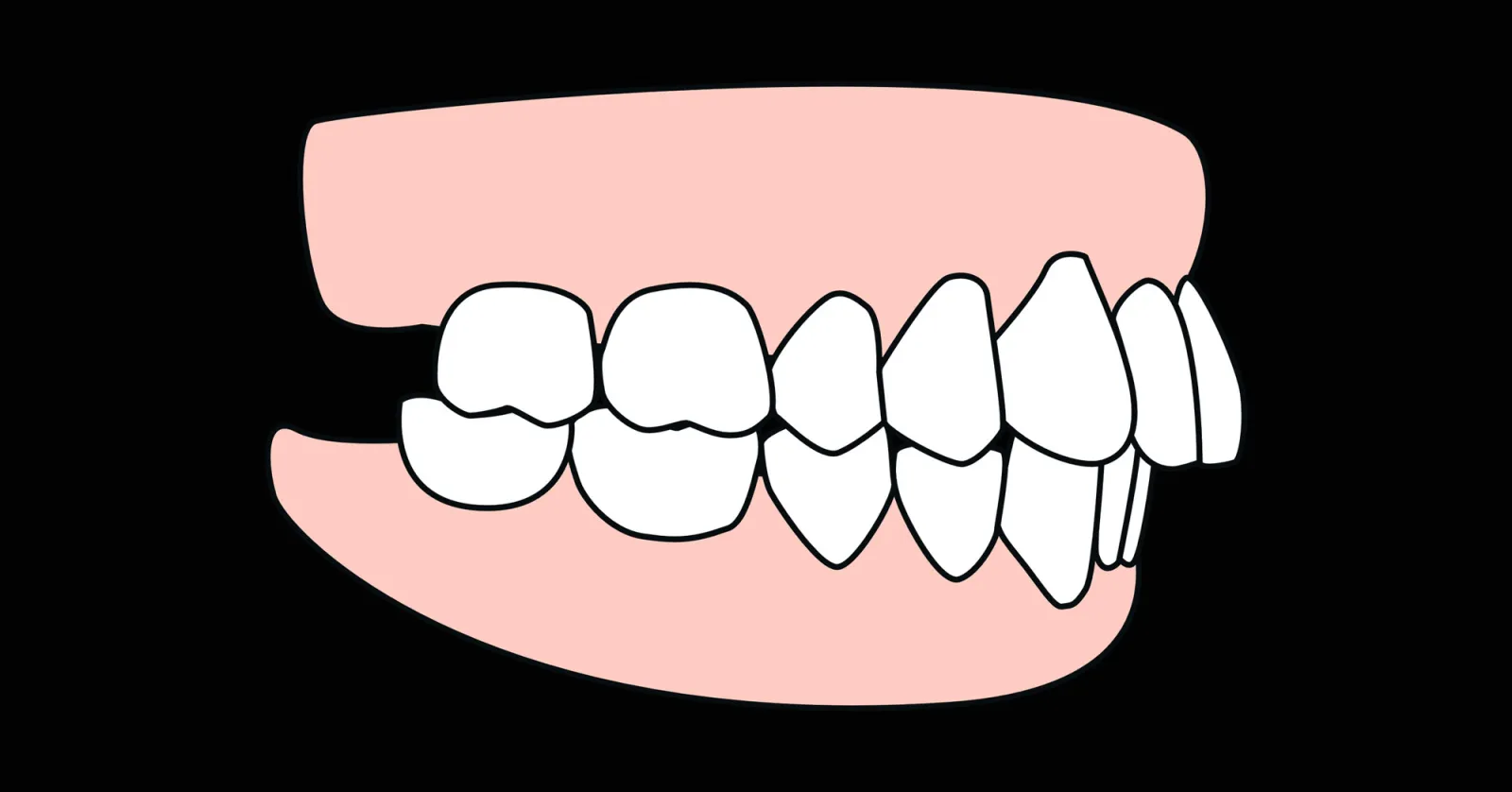 Dientes de arriba hacia afuera: causas y soluciones para corregir una sonrisa prominente