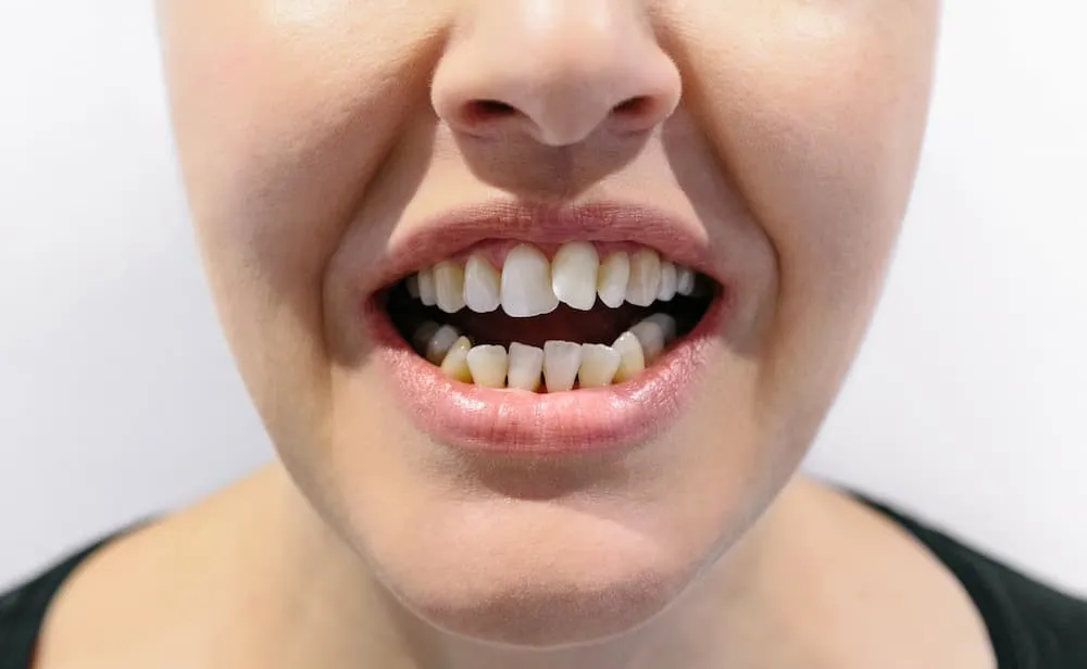 Dientes torcidos