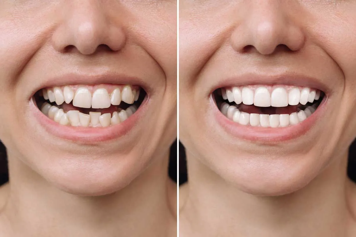 Diseño de sonrisa en la primera visita: descubre cómo será tu nueva sonrisa antes de empezar