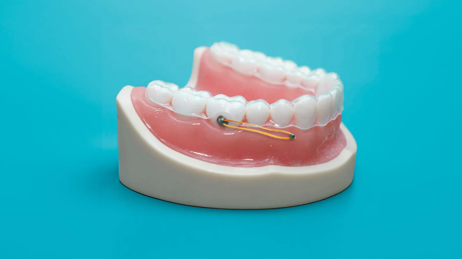 ¿Qué son los microtornillos de ortodoncia?
