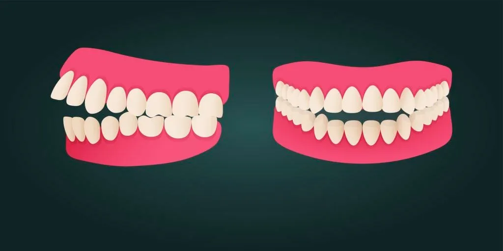 Los Tipos de maloclusión dental