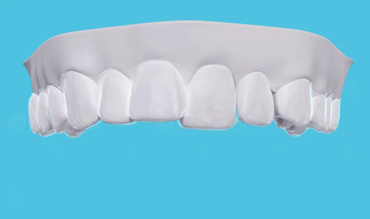 Tratamiento con alineadores para dientes torcidos: cómo corregirlos sin brackets y recuperar tu sonrisa